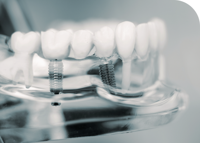 Dieses Bild zeigt Implantate von der MKG Olching